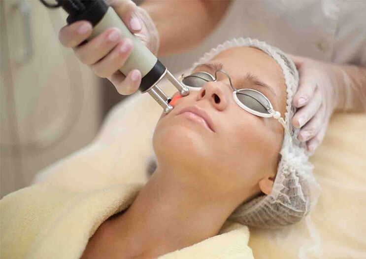 Laser-Hautverjüngungsverfahren um die Augen