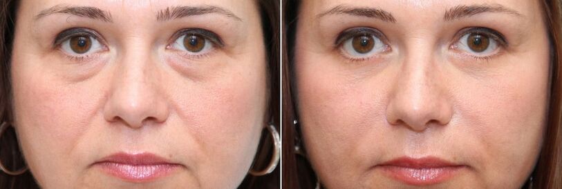 Vor und nach der Blepharoplastik - Entfernung des Fettkörpers unter den Augen und Hautstraffung