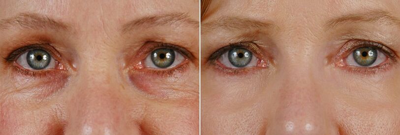 Vor und nach der Laseroperation - Verjüngung der Haut um die Augen