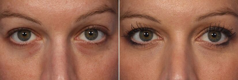 Vor und nach der Verwendung von injizierbaren Füllstoffen - Reduzierung von Augenringen